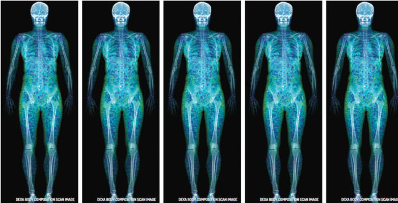 X is for DEXA&nbsp;X-ray
